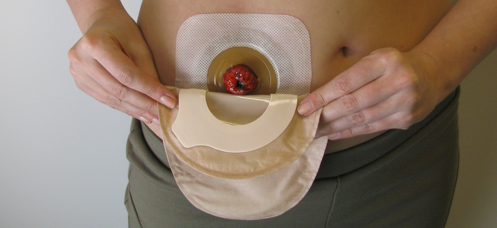 ConvaTec Esteem Synergy Versorgungswechsel Schritt f&uuml;r Schritt 07