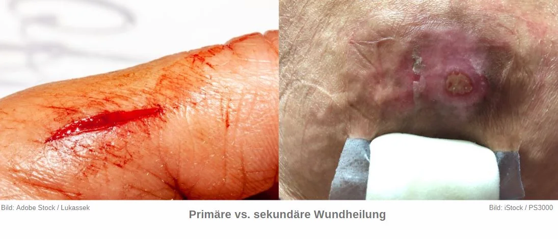 Primäare vs. sekundäre Wundheilung