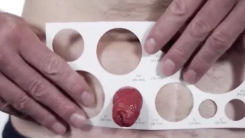 Illustration of stoma